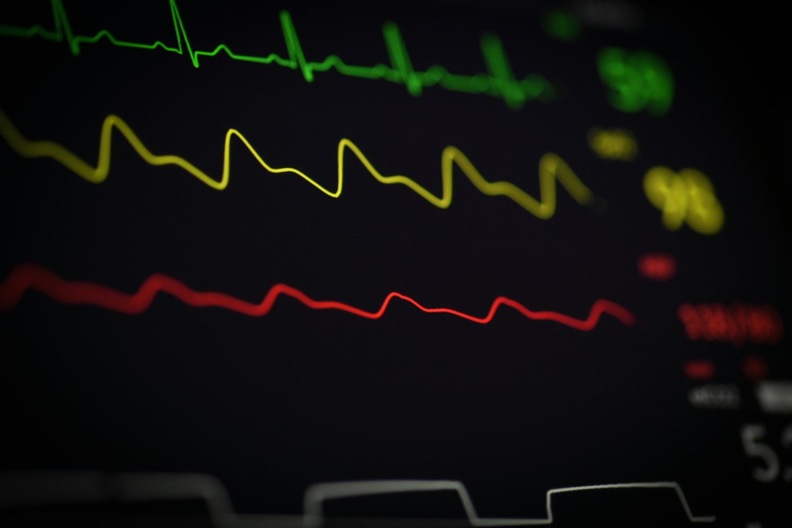 ECG waveform displayed on a clinical monitor